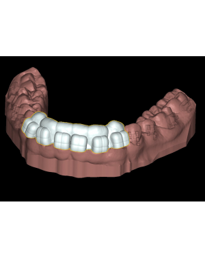Deltaface 3D Orthodontic Design Software - IDB for indirect bonding
