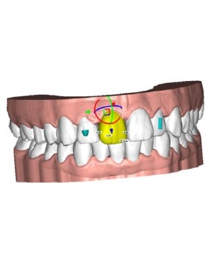 Deltaface 3D Orthodontic Design Software - Aligner for clear aligners