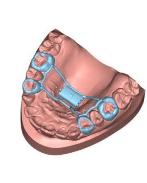 Deltaface 3D Orthodontic Design Software - Appliance for orthodontic appliances