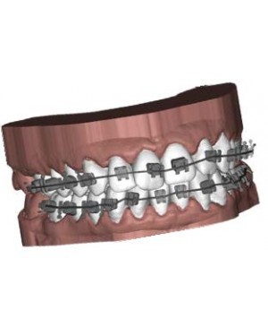 Deltaface 3D Orthodontic Design Software - Ubrackets for customised brackets and indirect bonding